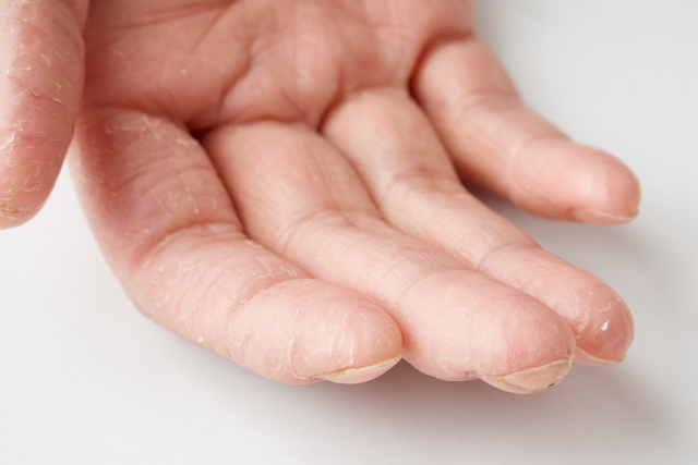 手湿疹でもネイルできる 手湿疹の人や肌が弱い人のネイル注意点など